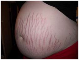 stretch mark