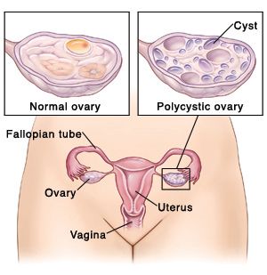 pcos