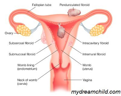 spiritual-root-of-uterine-fibroids