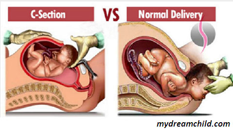 Vaginal Delivery v/s cesarean section